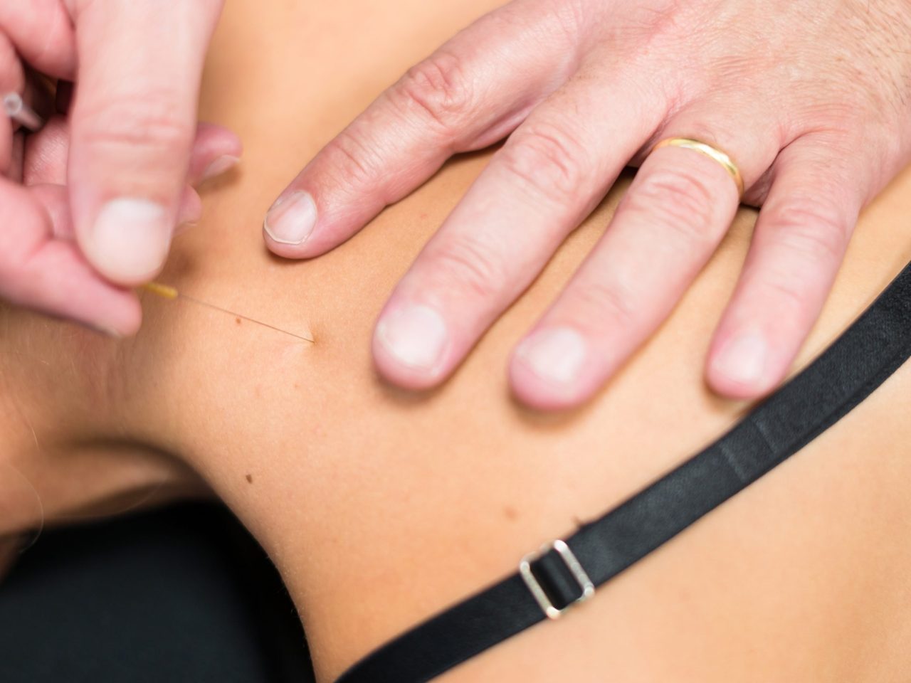 Dry Needling Dry Needling